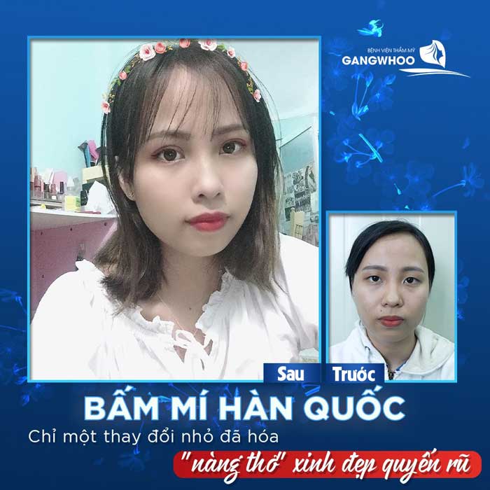 Cắt mí mắt ở đâu đẹp tại Quảng Trị là chất lượng nhất