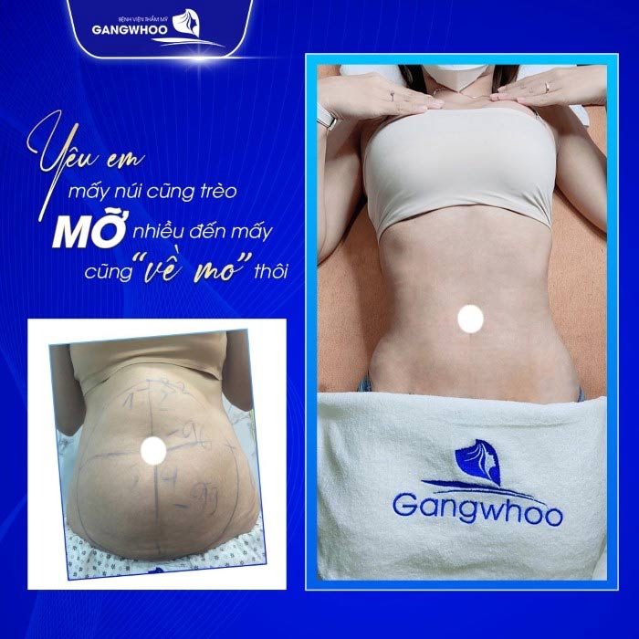 Khách hàng trải nghiệm dịch vụ hút mỡ bụng Lipo Ultrasound tại BVTM Gangwhoo