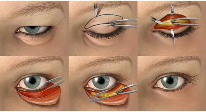 Tác hại của cắt mí mắt