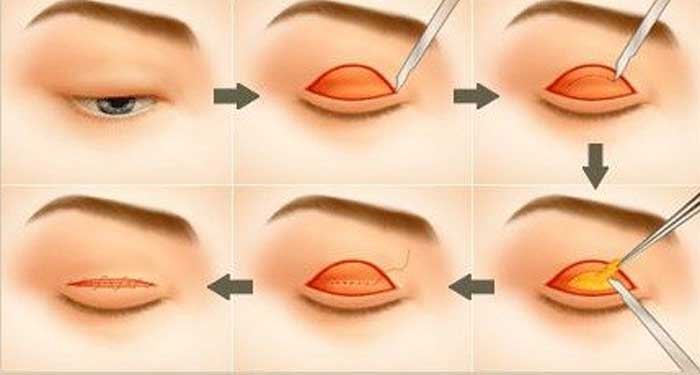 Kỹ thuật cắt mí mắt