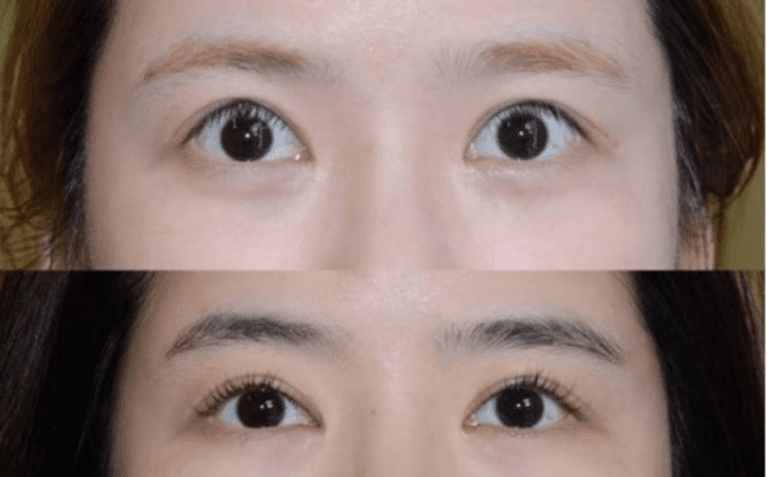 Cắt Mí Hỏng Sửa Lại Liền Được Không? Bí Quyết Để Có Đôi Mắt Đẹp Như Ý